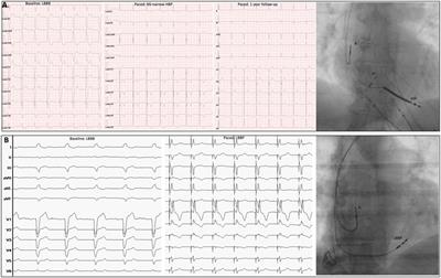 The weakest point of cardiac resynchronization therapy: new technologies facing old terminology